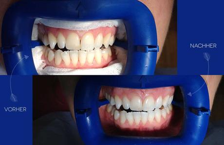 Endlich weiße Zähne – Meine zweite Bleaching Behandlung