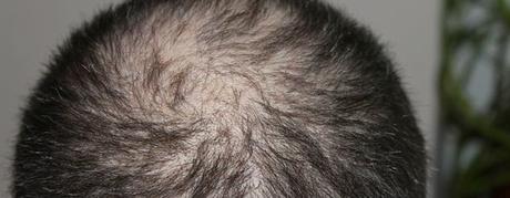 WARNUNG! ᐅ Haarwachstumsmittel bedenkenlos? (TEST 2019)