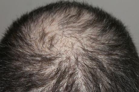 WARNUNG! ᐅ Haarwachstumsmittel bedenkenlos? (TEST 2019)