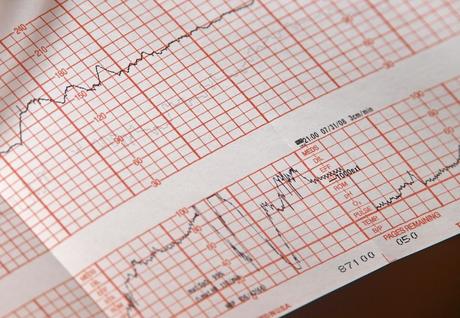 Smartwatch – So funktioniert EKG und Blutdruckmessung