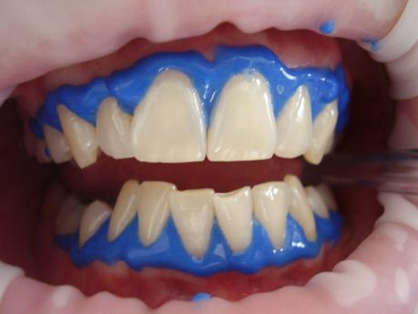 Hausmittel oder Zahnersatz für weiße Zähne? Zähne aufhellen durch Bleaching