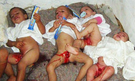 Schluss mit Verstümmelung von Jungen und Mädchen im Säuglings- oder Kleinkindalter