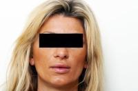 Dr. Clarence P. Davis antwortet auf Fragen zum Thema Eigenfett-Transplantation