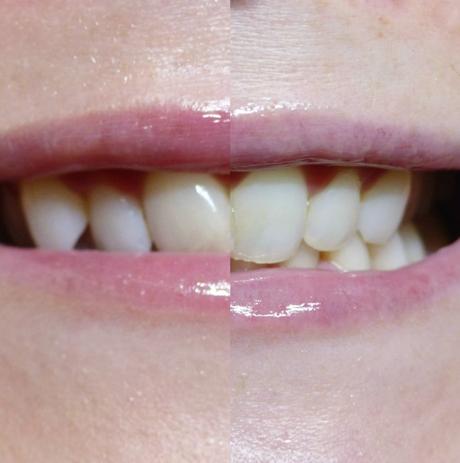 V-White Vitamin Enriched Whitening Toothpaste - Review + Blogparade Vorher Nachher 2