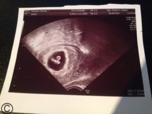 Blogparade „Überraschung, ich bin schwanger“ #ichhabesgesagt