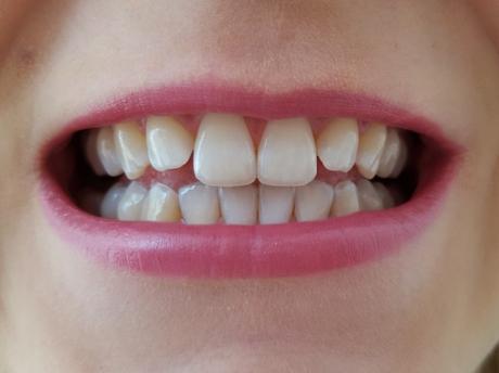 Alpine White Whitening Strips für schnell weisse Zähne