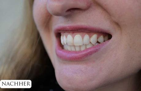 Zähne bleachen – endlich weiße Zähne