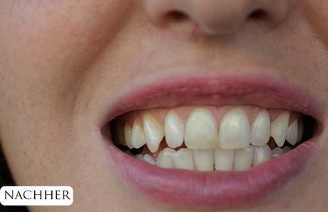 Zähne bleachen – endlich weiße Zähne