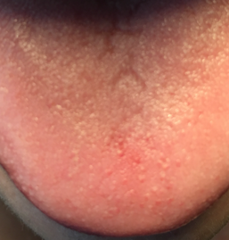 Querfurchen auf der Zunge als Zeichen für empfindsames Nervensystem