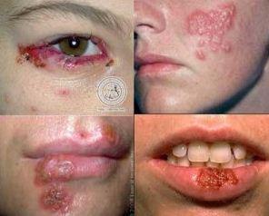 obat herpes buat balita