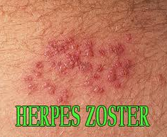 Cara Menyembuhkan Herpes