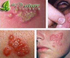 obat herpes bagi ibu hamil