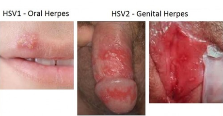 Cara Mengatasi Herpes