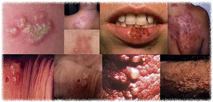 Penyakit Herpes
