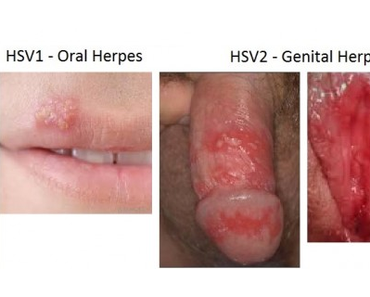 obat herpes bibir