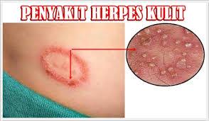 Obat Herpes Alami
