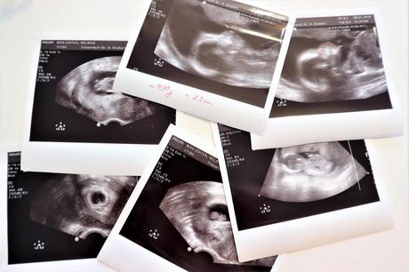 Schwangerschaft #3 (14-23 Woche)