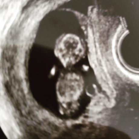 Ultraschall 11+2, 4,8cm Embryo