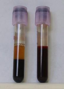 Links: Abgestandene Blutprobe - oben zellfreies Blutplasma, unten zelluläre Bestandteile