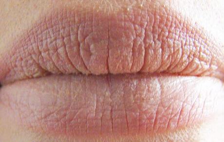 [106] Wie bekommt man vollere Lippen?