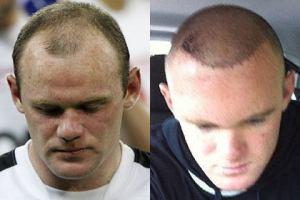 Wayne Rooney redet offen über seinen Haarausfall