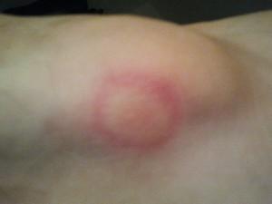 Was macht der rote, kreisförmige Kranz auf meinem Knöchel?