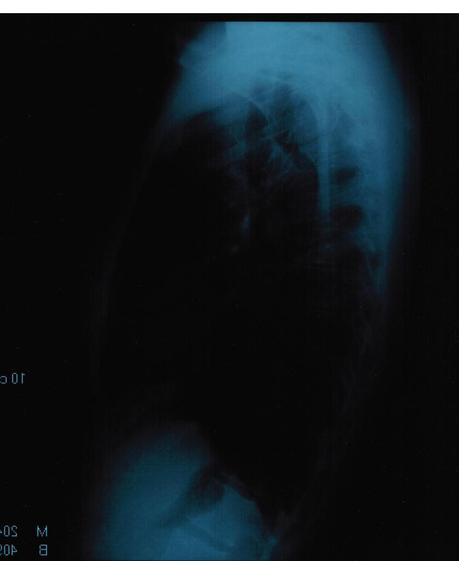Lunge. Röntgenbilder.