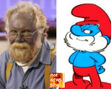 Papa Schlumpf lebt? Amerikaner mit blauem Gesicht