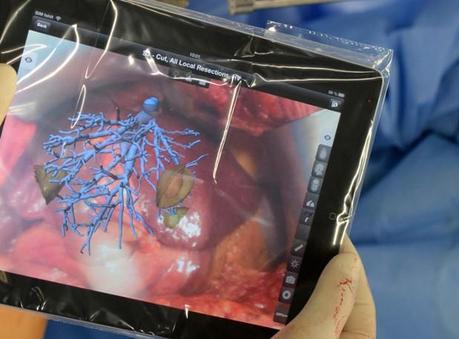 App für Leber OP: Stehen Ärzte bald mit iPad am OP Tisch?