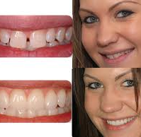 Veneers