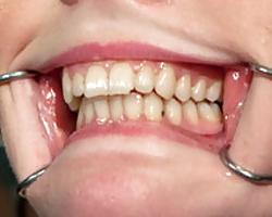 Bild von Zähne einer Frau