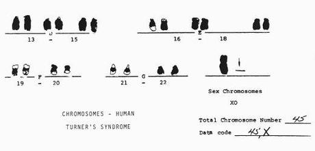 Turner's Syndrome Chromosomes