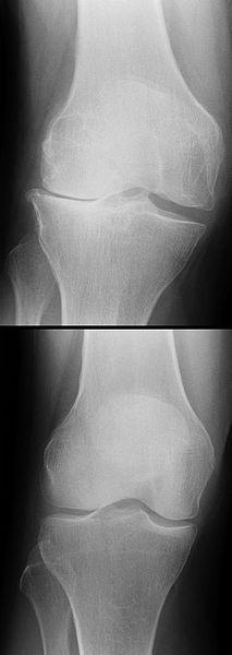 Röntgenbild einer lateralen Gonarthrose (oben) im Vergleich zu einem normalen Kniegelenk (unten) -By J. Lengerke. Wikipedia [CC-BY-SA-3.0-de (http://creativecommons.org/licenses/by-sa/3.0/de/deed.en)], from Wikimedia Commons