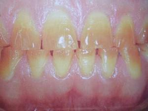 Zahnverfärbungen als UW von Tetrazyklin