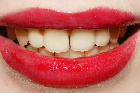 Smile Brilliant Teeth Whitening Part II • German Version
