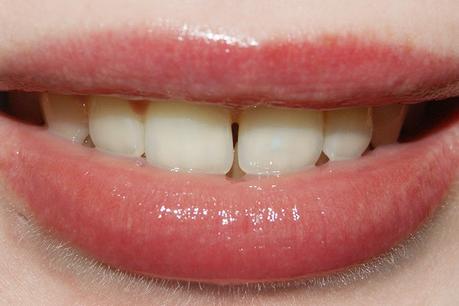 Smile Brilliant Teeth Whitening Part II • German Version